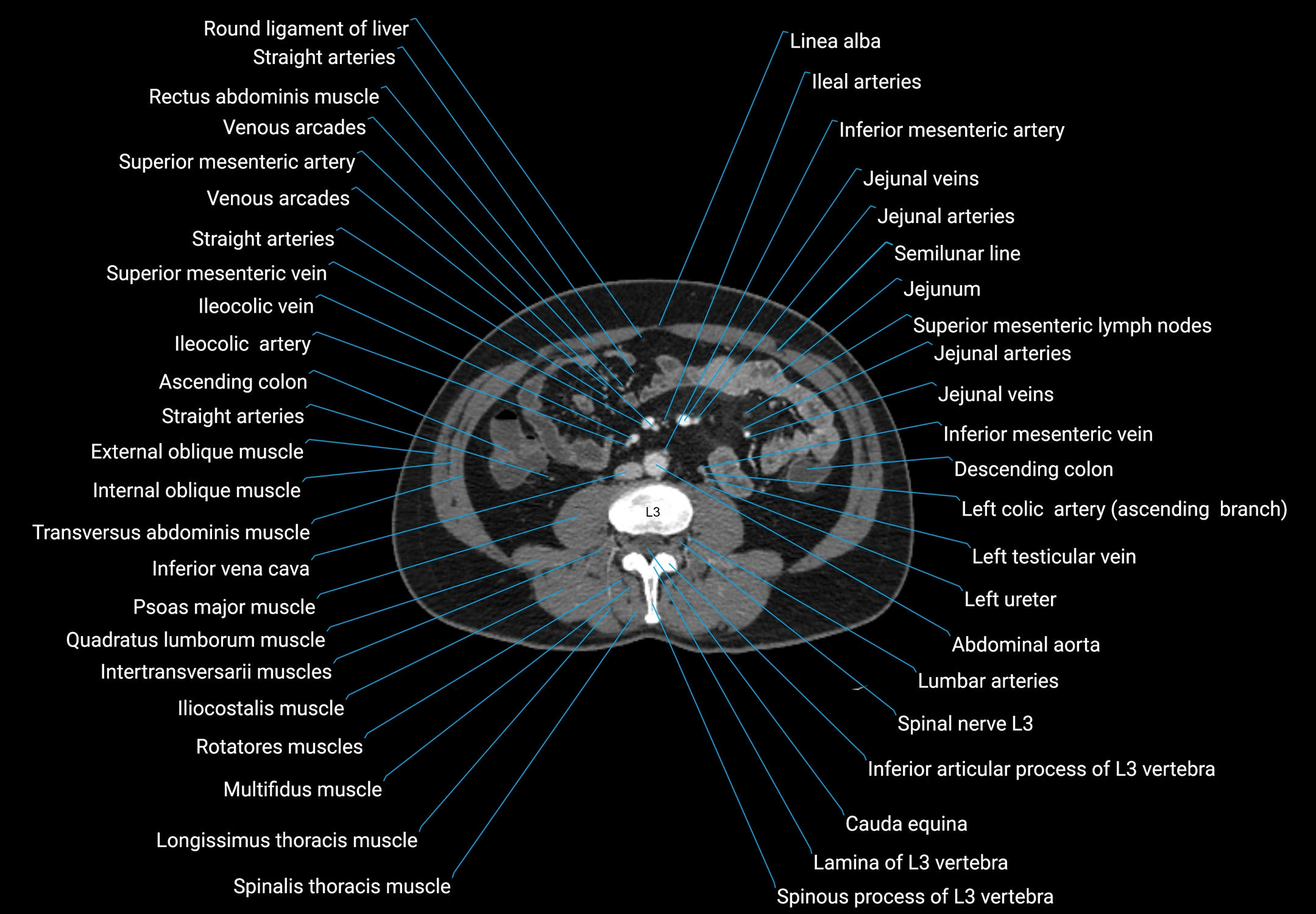 CT male pelvis axial cross sectional anatomy labelled radiology image -00096.webp